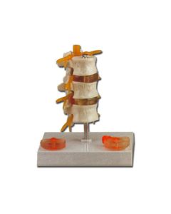 Lumbar with Herniated Disc